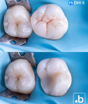 The Biomimetic Concept: Composite Restoration Protocols