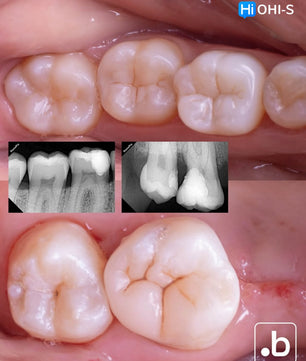 The Biomimetic Concept: Composite Restoration Protocols
