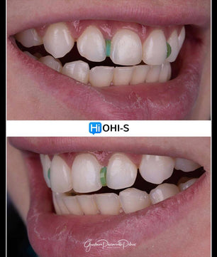 Composite Veneers, All Restorative Techniques