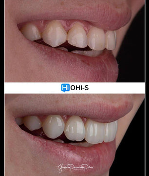 Composite Veneers, All Restorative Techniques
