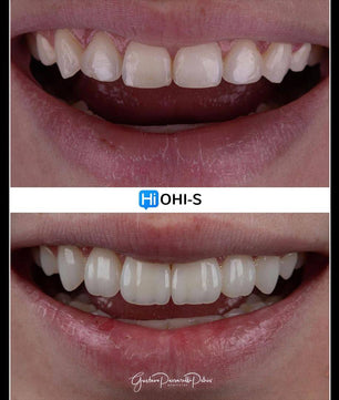 Composite Veneers, All Restorative Techniques