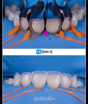 Composite Veneers, All Restorative Techniques