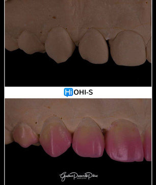 Composite Veneers, All Restorative Techniques