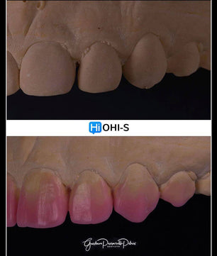 Composite Veneers, All Restorative Techniques
