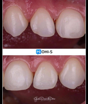 Composite Veneers, All Restorative Techniques