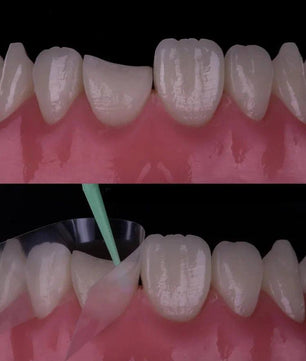 Composite Veneers, All Restorative Techniques