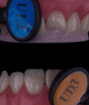 Composite Veneers, All Restorative Techniques