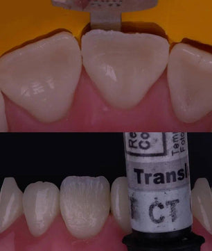 Composite Veneers, All Restorative Techniques