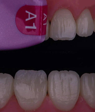 Composite Veneers, All Restorative Techniques