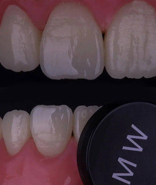 Composite Veneers, All Restorative Techniques