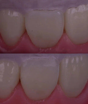 Composite Veneers, All Restorative Techniques