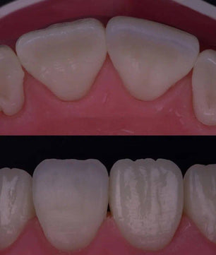 Composite Veneers, All Restorative Techniques