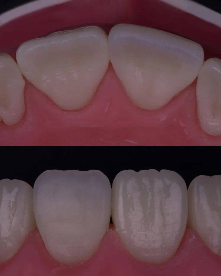 Composite Veneers, All Restorative Techniques