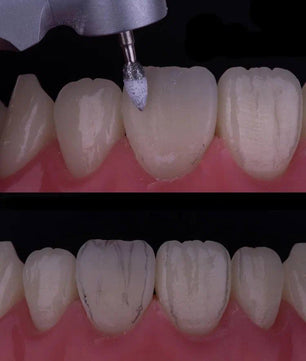 Composite Veneers, All Restorative Techniques