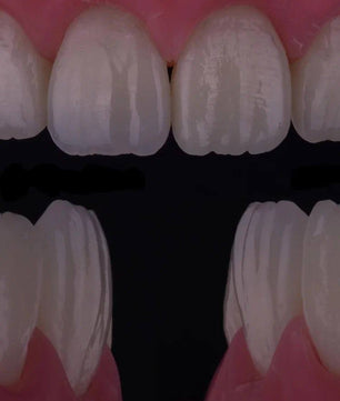Composite Veneers, All Restorative Techniques