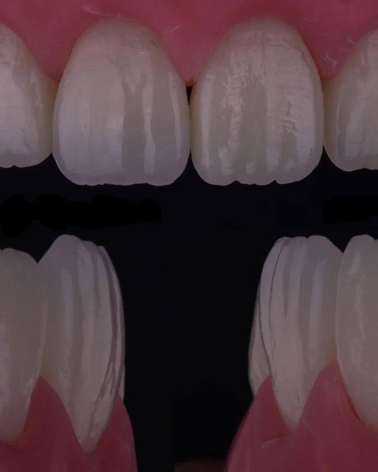 Composite Veneers, All Restorative Techniques