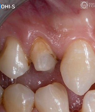 Vertical Preparation Protocols: The Complete Guide in 24 Lessons from Tomorrow Tooth