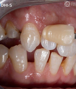 Vertical Preparation Protocols: The Complete Guide in 24 Lessons from Tomorrow Tooth