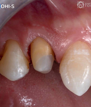 Vertical Preparation Protocols: The Complete Guide in 24 Lessons from Tomorrow Tooth