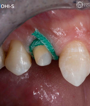 Vertical Preparation Protocols: The Complete Guide in 24 Lessons from Tomorrow Tooth