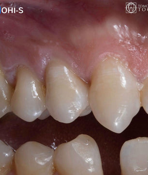 Vertical Preparation Protocols: The Complete Guide in 24 Lessons from Tomorrow Tooth