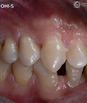 Vertical Preparation Protocols: The Complete Guide in 24 Lessons from Tomorrow Tooth