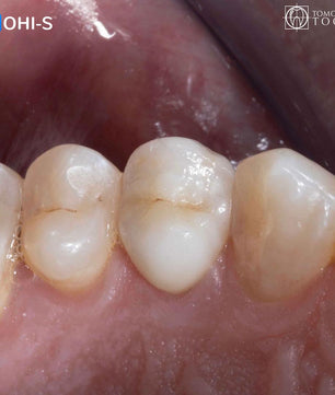 Vertical Preparation Protocols: The Complete Guide in 24 Lessons from Tomorrow Tooth