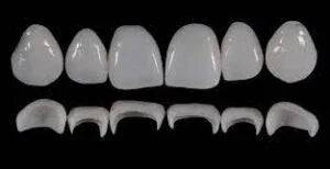 Prosthetic Rehabilitation on Natural Teeth: Predictable, Esthetic and Systematic Steps
