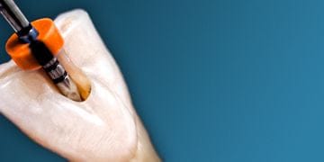 Root perforations - diagnosis and treatment
