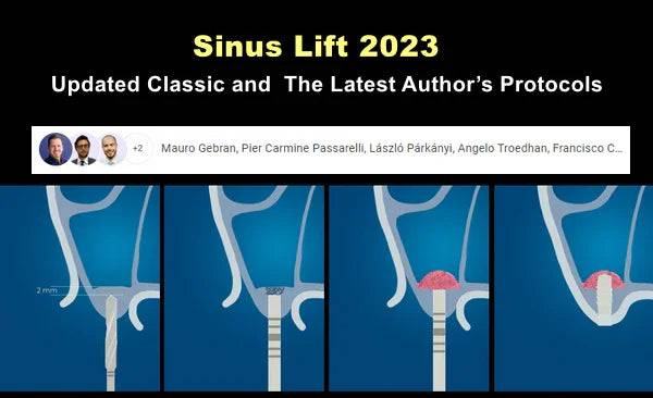 Sinus Lift 2023: Updated Classic & The Latest Author’s Protocols