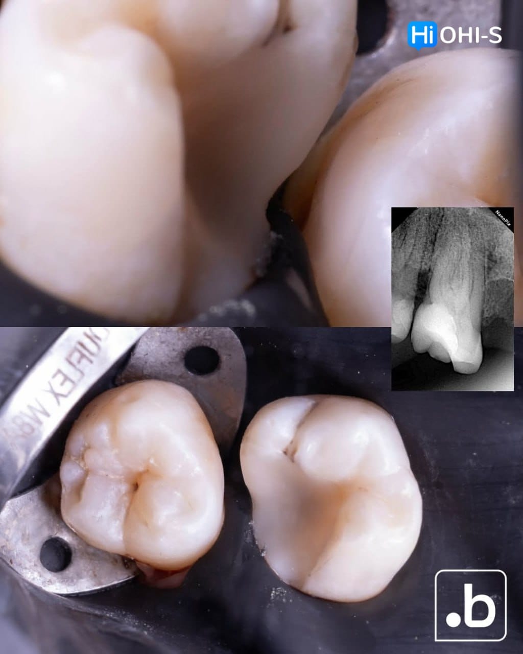 The Biomimetic Concept: Composite Restoration Protocols