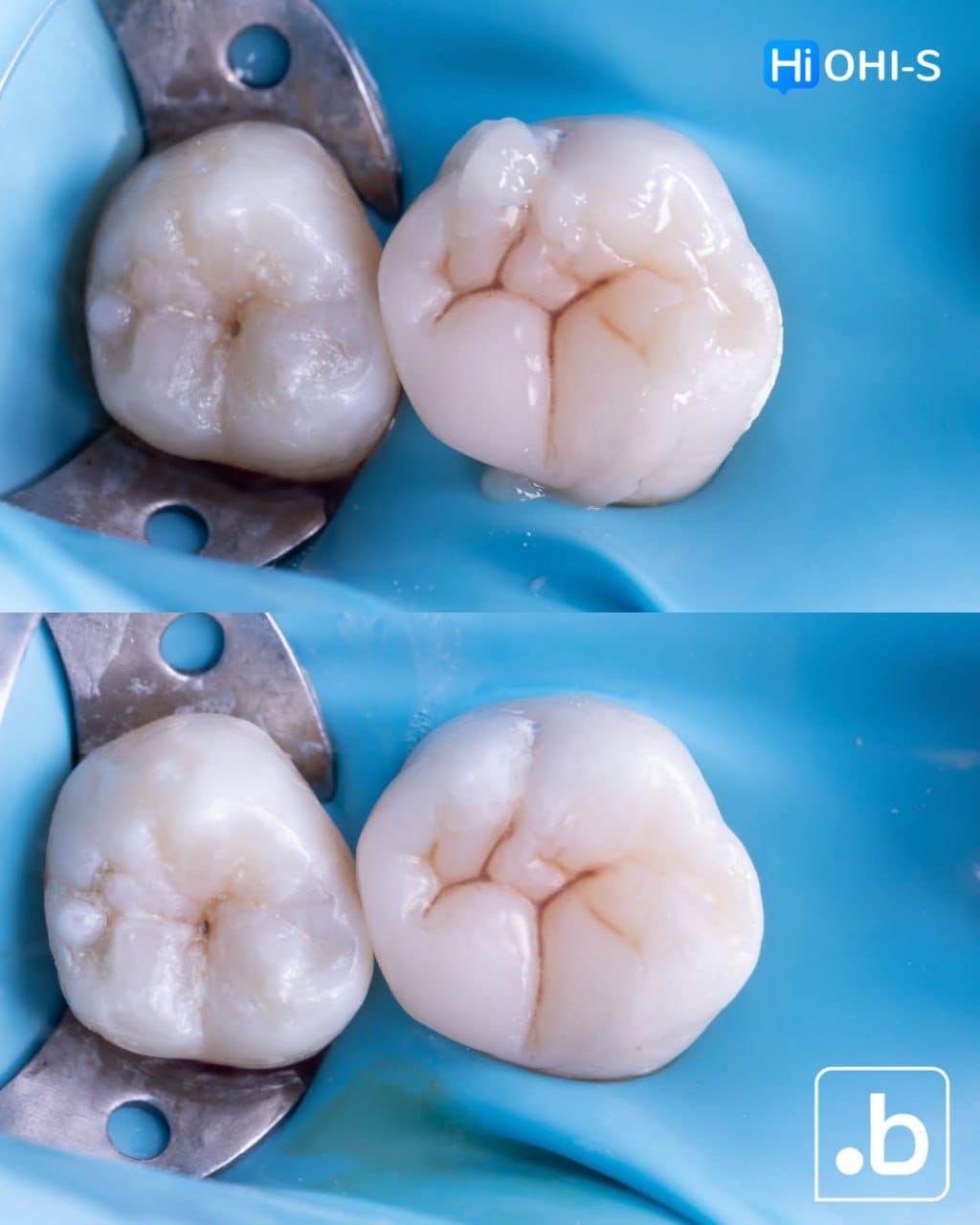 The Biomimetic Concept: Composite Restoration Protocols
