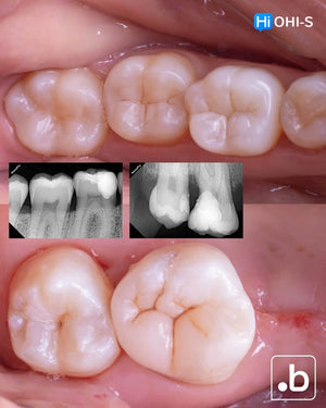 The Biomimetic Concept: Composite Restoration Protocols