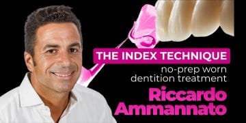 The Index Technique. No-prep worn dentition treatment