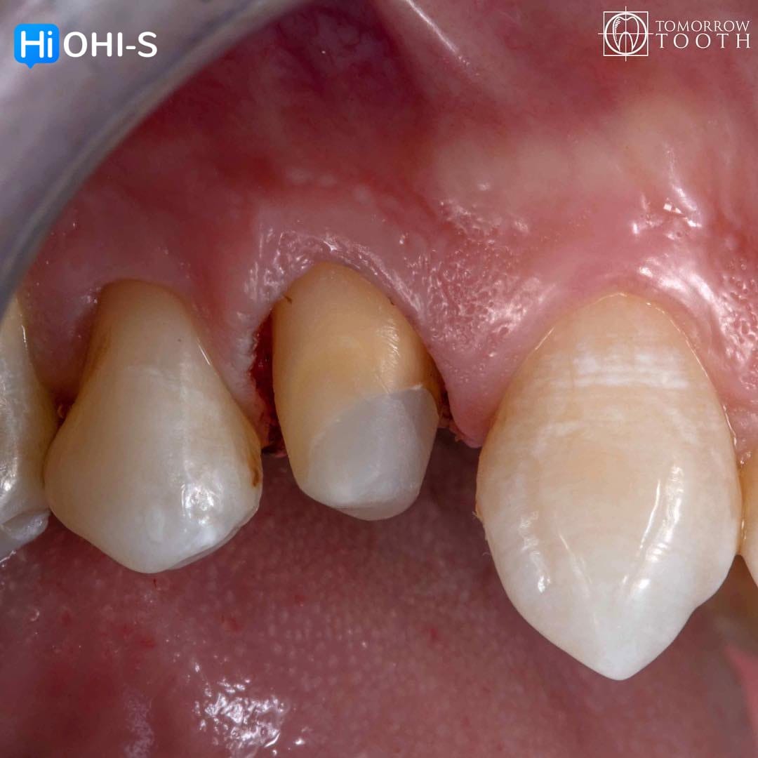 Vertical Preparation Protocols: The Complete Guide in 24 Lessons from Tomorrow Tooth