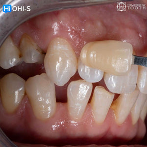 Vertical Preparation Protocols: The Complete Guide in 24 Lessons from Tomorrow Tooth