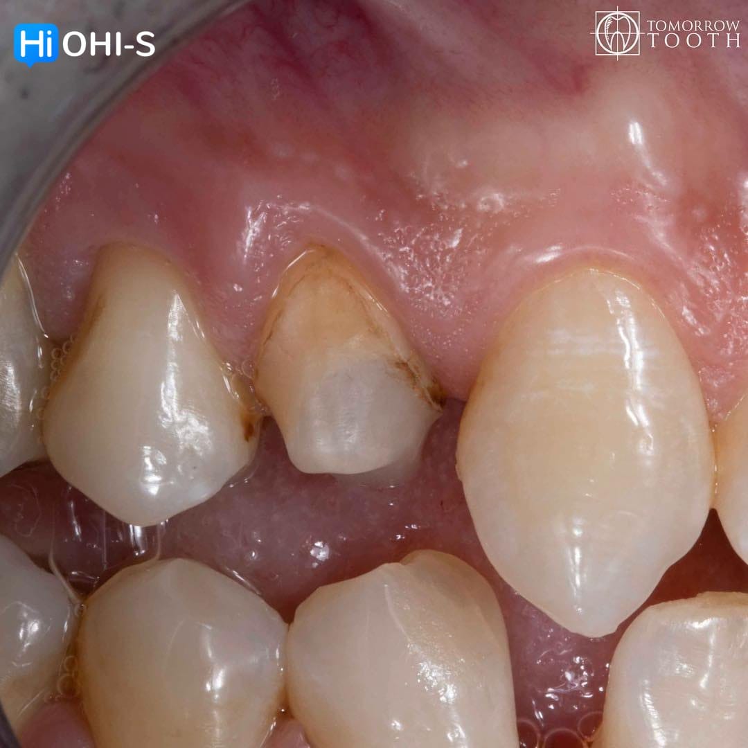 Vertical Preparation Protocols: The Complete Guide in 24 Lessons from Tomorrow Tooth