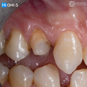 Vertical Preparation Protocols: The Complete Guide in 24 Lessons from Tomorrow Tooth