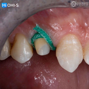 Vertical Preparation Protocols: The Complete Guide in 24 Lessons from Tomorrow Tooth