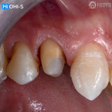 Vertical Preparation Protocols: The Complete Guide in 24 Lessons from Tomorrow Tooth