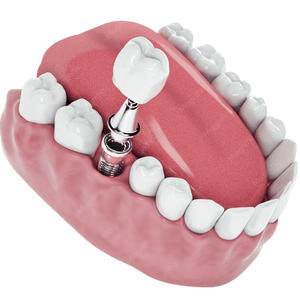 Implantology